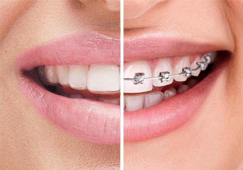 تقويم الاسنان - عيادة جمس -GEMS Dental Clinic