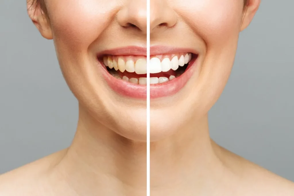 تبييض الاسنان - عيادة جمس -GEMS Dental Clinic