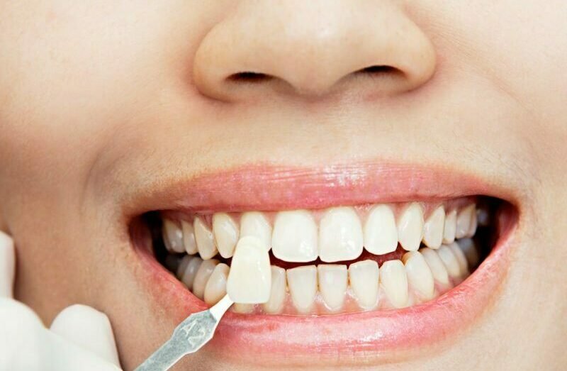 تركيبات الأسنان - عيادة جمس -GEMS Dental Clinic