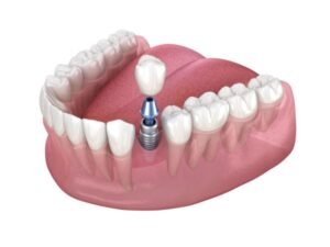 زراعة الاسنان - عيادة جمس -GEMS Dental Clinic