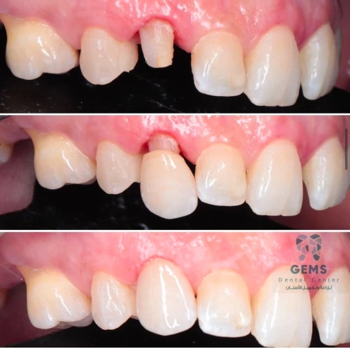 شكل طربوش الاسنان- انواع طرابيش الاسنان واسعارها