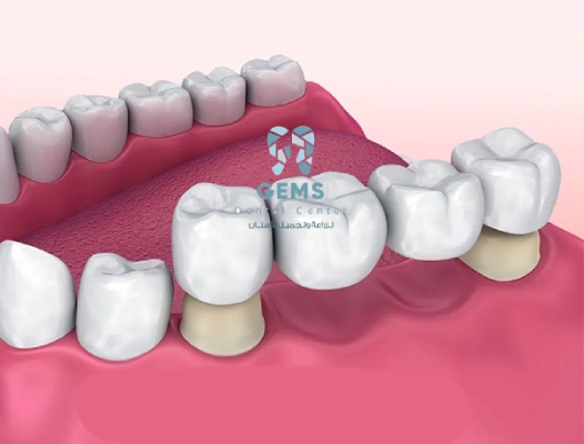 انواع طقم الاسنان - بريدج الاسنان