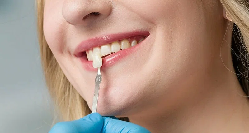 سعر تركيب سنة امامية - GEMS Dental Clinic