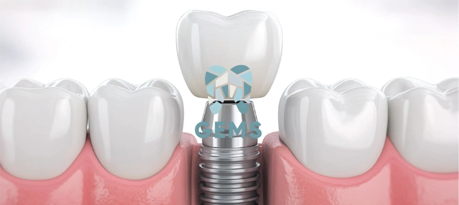 ما هي الزراعه الفوريه للاسنان