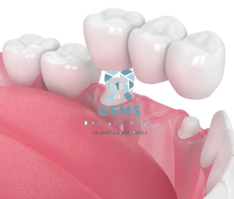 البريدج للاسنان