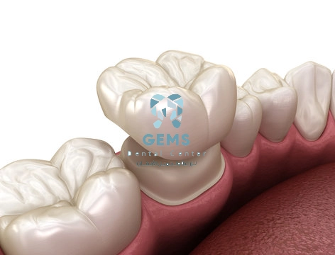 سعر تركيب ضرس واحد