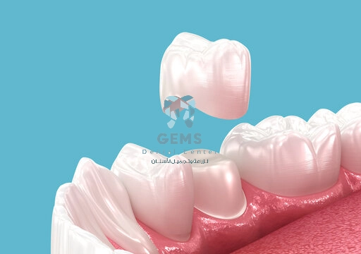 سعر تركيب ضرس واحد