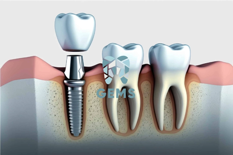 ما هي الزراعه الفوريه للاسنان