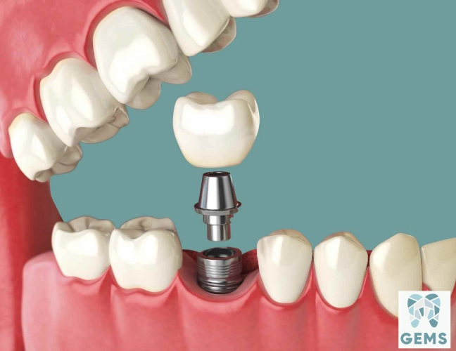 ما هي الزراعه الفوريه للاسنان