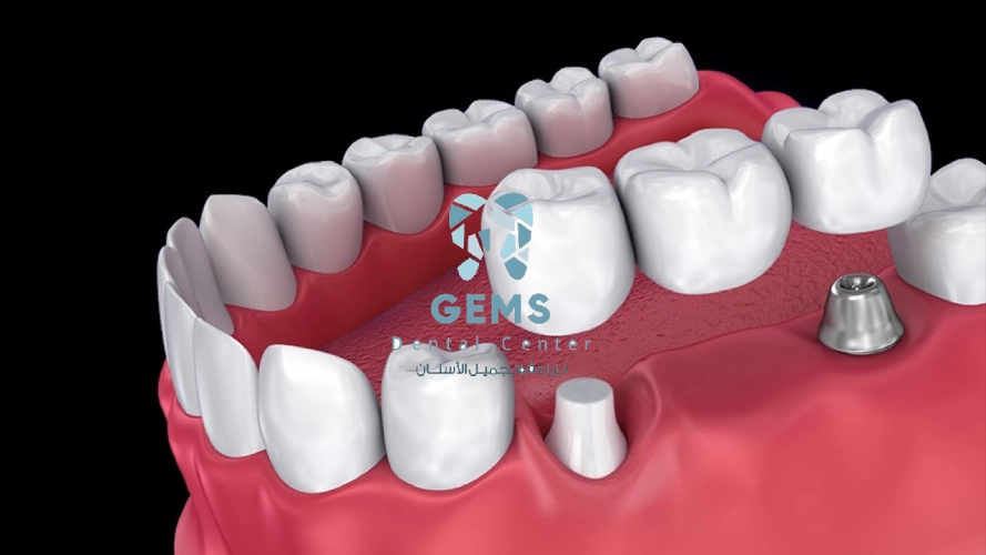 هل تركيب الاسنان افضل ام الزراعه