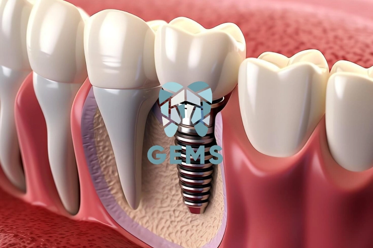 هل تركيب الاسنان افضل ام الزراعه